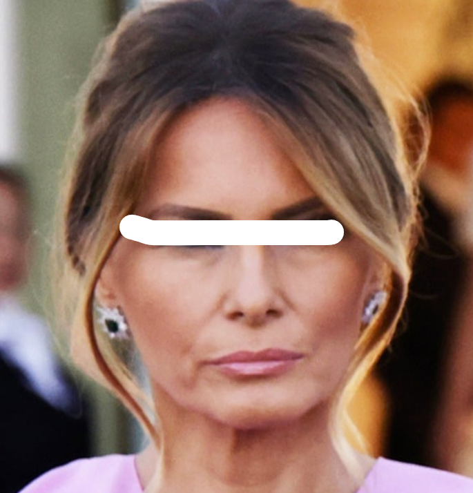 Un détail du visage de Melania révélé… et cela confirme que les rumeurs étaient vraies
